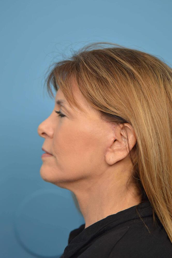Neck Lift Before & After