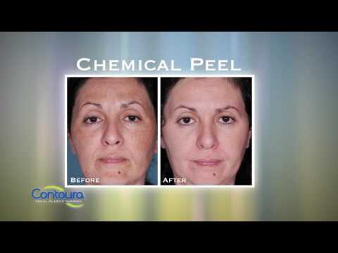 Dr. Roberto Garcia - Contoura Facial Plastic Surgery - Chemical Peel HD1