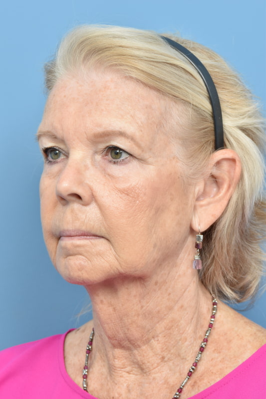 Brow Lift Before & After