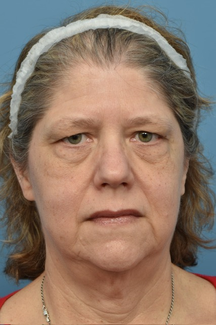 Brow Lift Before & After