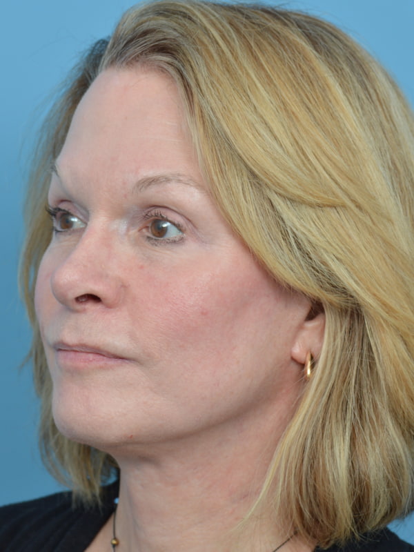 Brow Lift Before & After