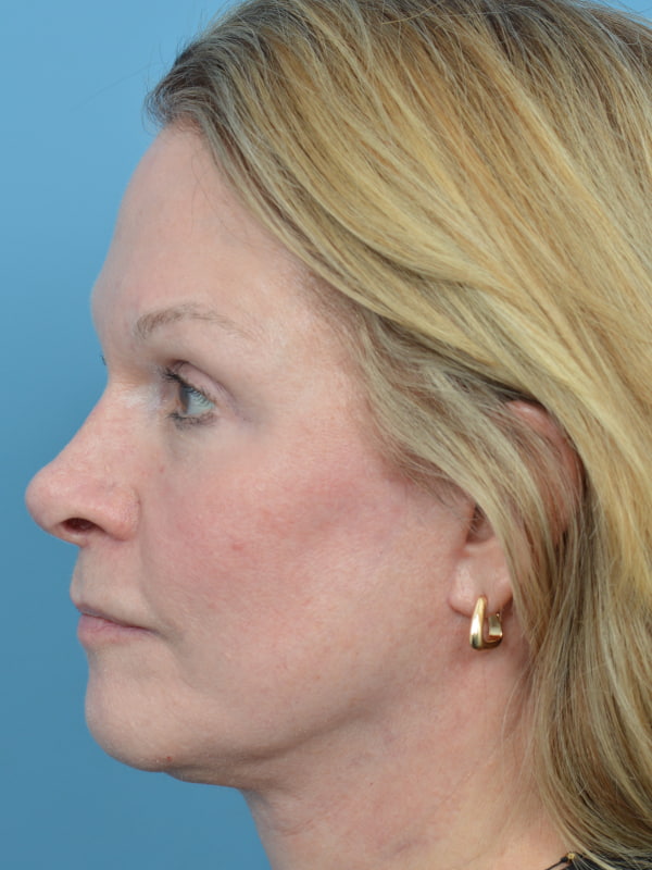 Brow Lift Before & After