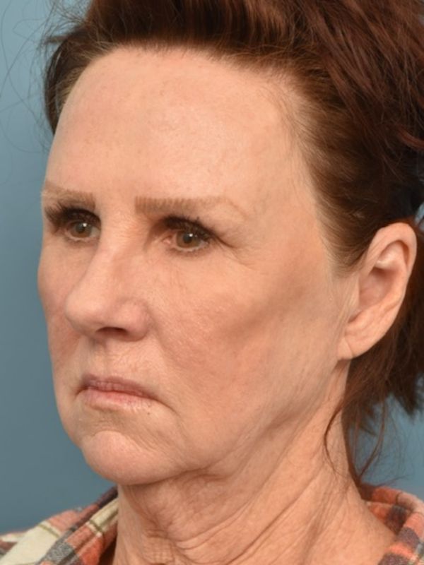 Brow Lift Before & After