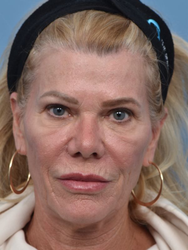 Brow Lift Before & After