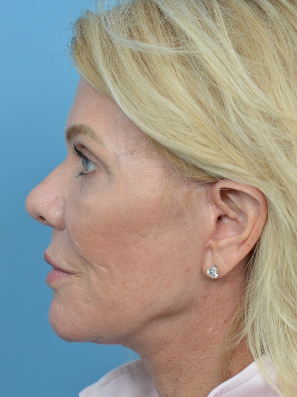 Brow Lift Before & After