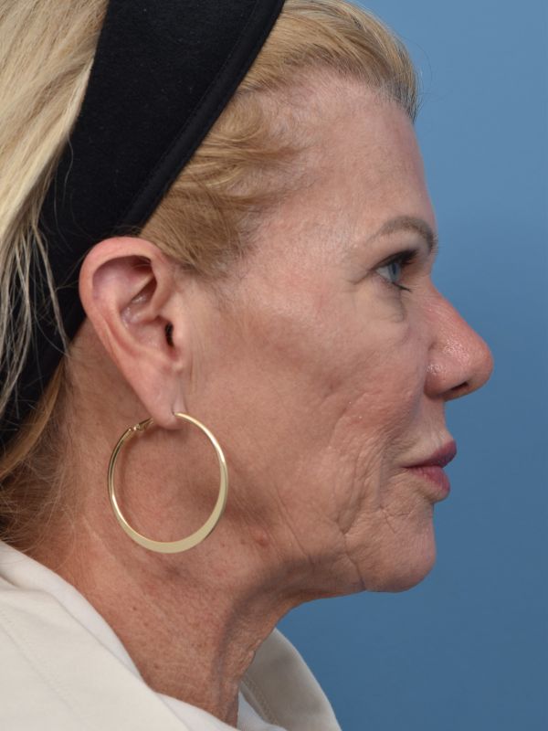 Brow Lift Before & After