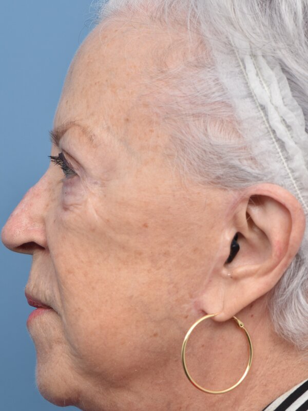 Brow Lift Before & After
