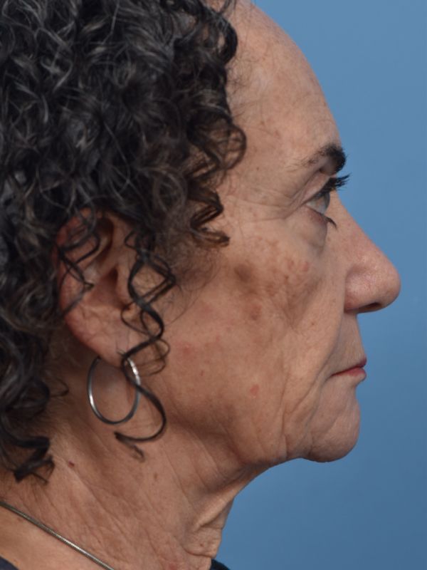 Fat Transfer Before & After