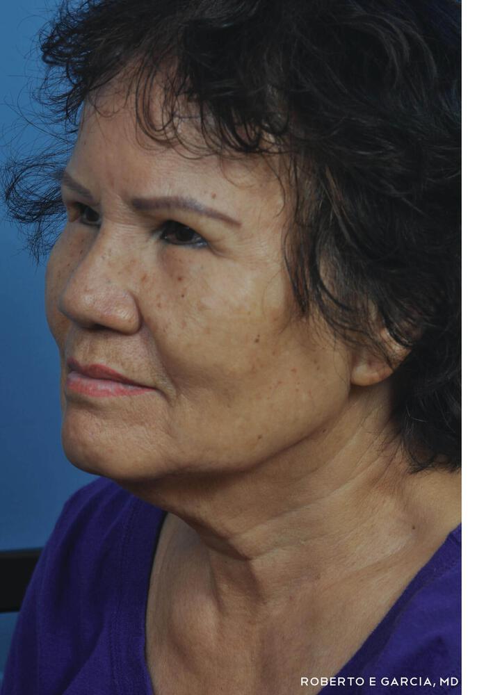 Contoura Lift Before & After