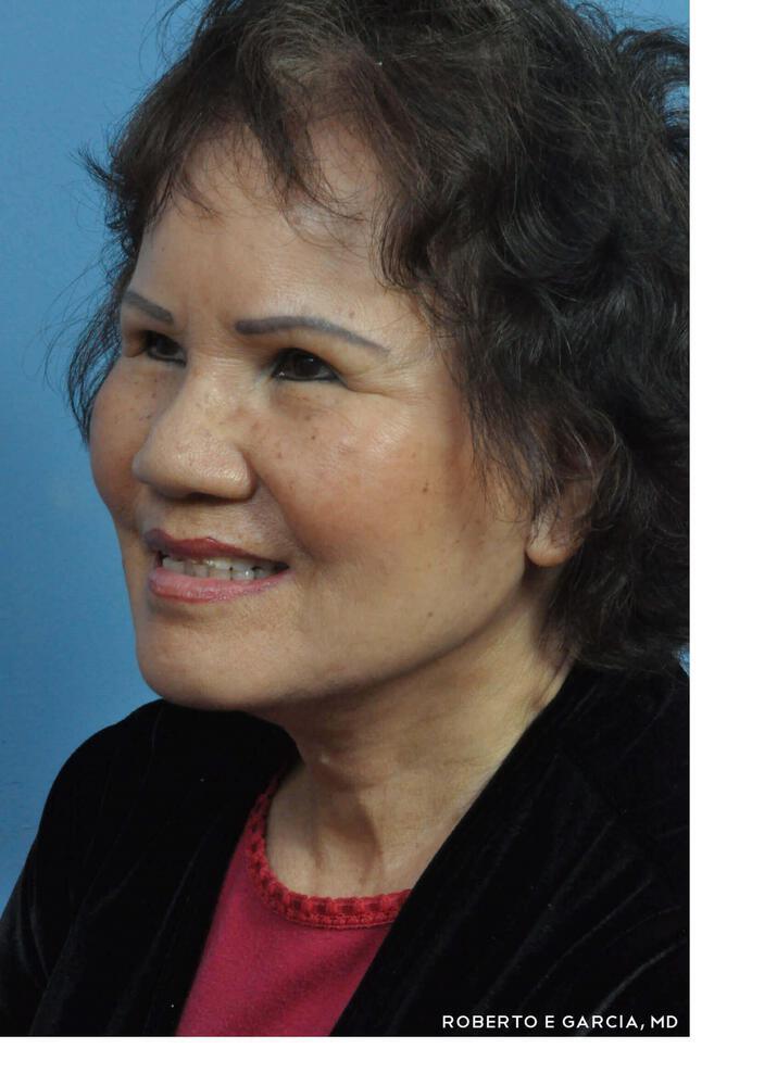 Contoura Lift Before & After