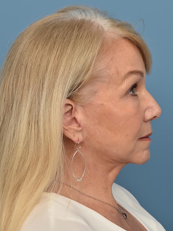 Contoura Lift Before & After