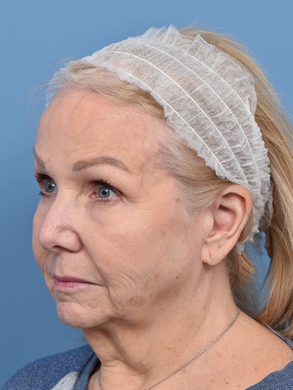 Contoura Lift Before & After