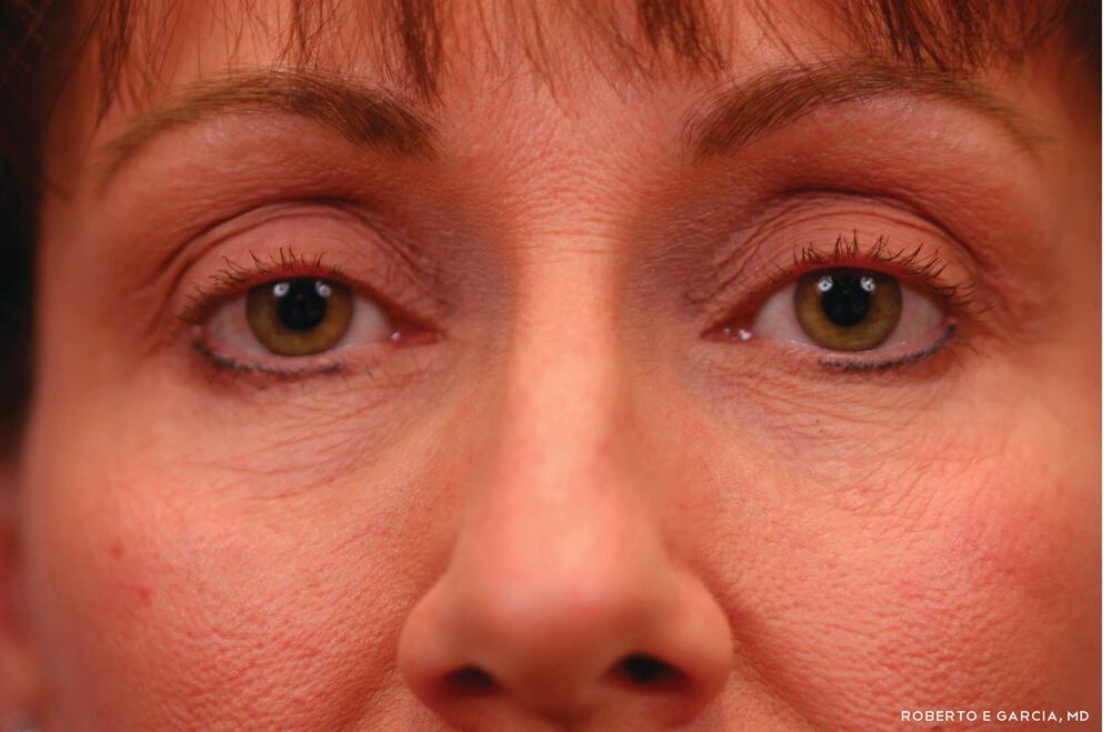 Eyelid Lift Before & After