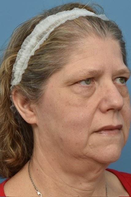 Blepharoplasty Before & After