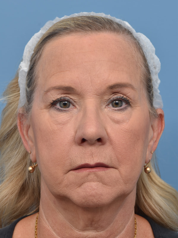 Blepharoplasty Before & After