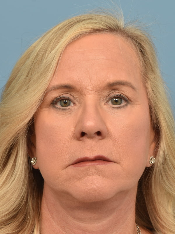 Blepharoplasty Before & After