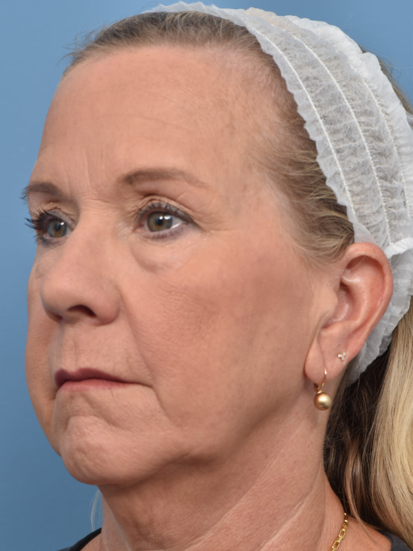 Blepharoplasty Before & After