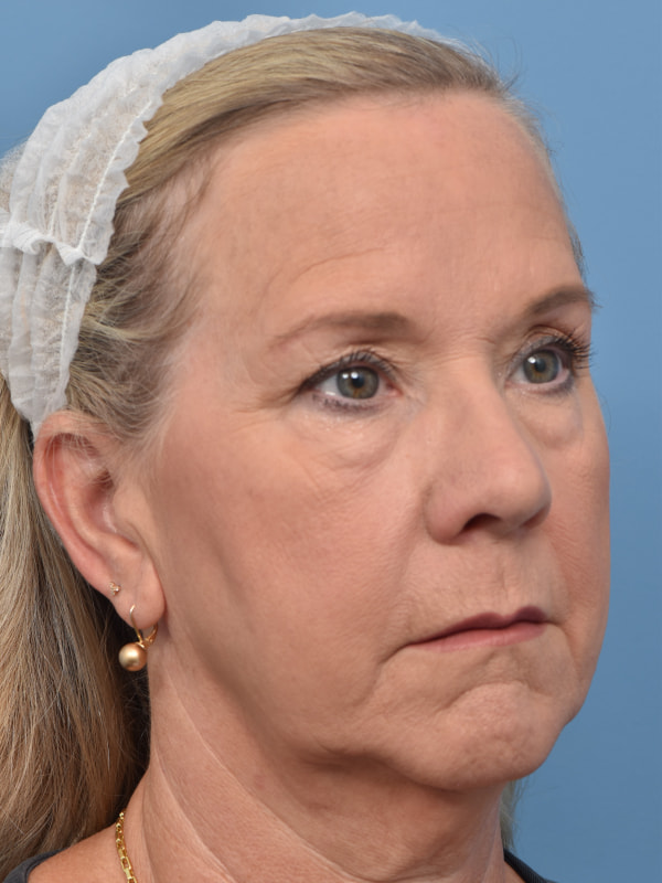 Blepharoplasty Before & After