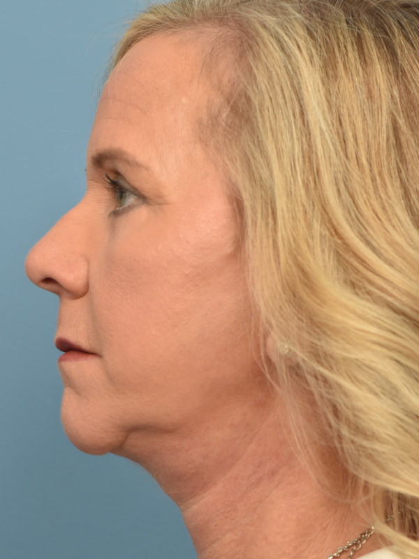 Blepharoplasty Before & After