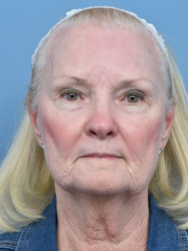 Blepharoplasty Before & After