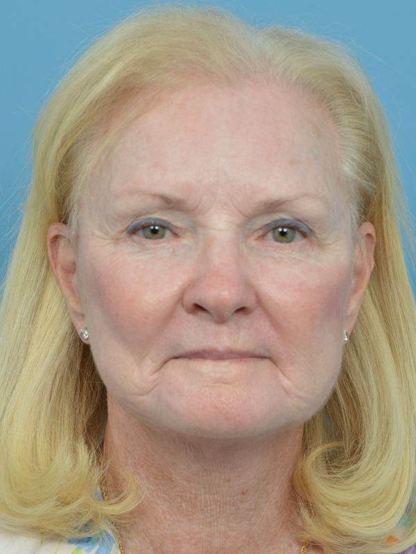 Blepharoplasty Before & After