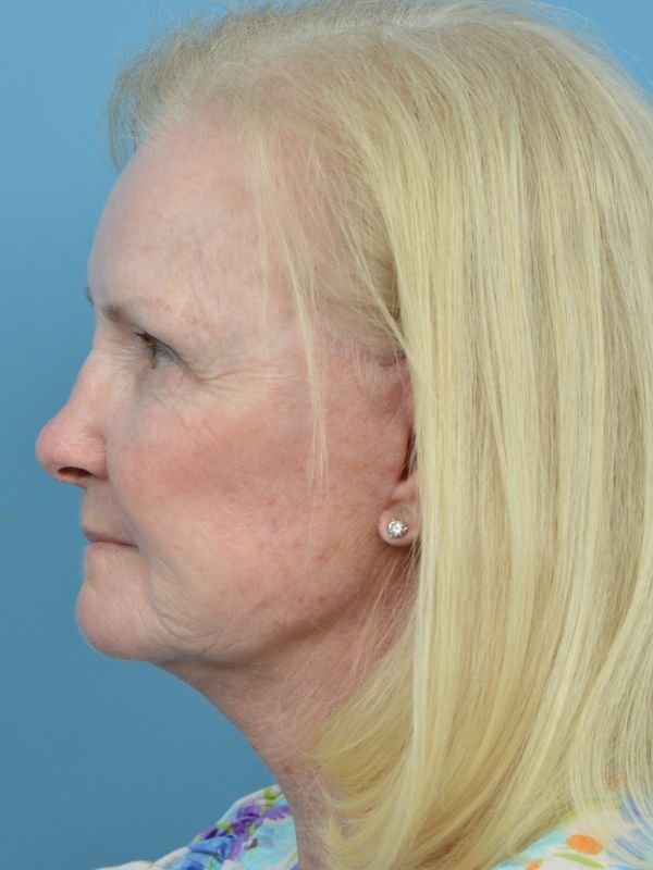 Blepharoplasty Before & After