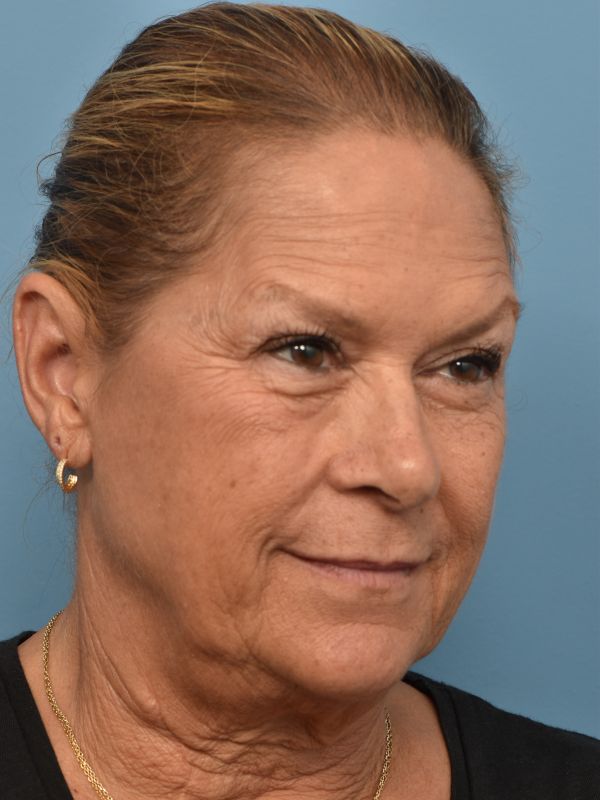 Blepharoplasty Before & After