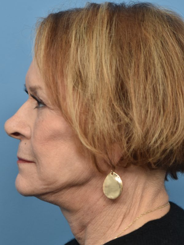 Blepharoplasty Before & After