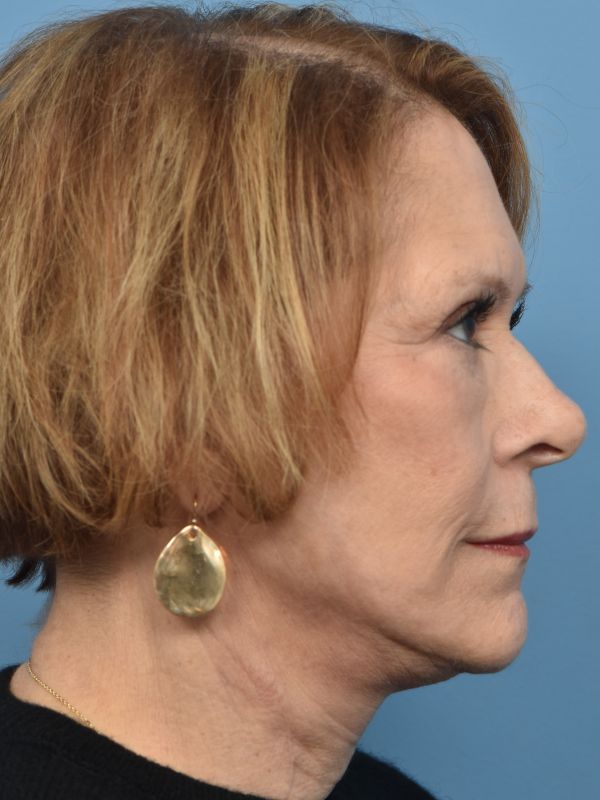 Blepharoplasty Before & After