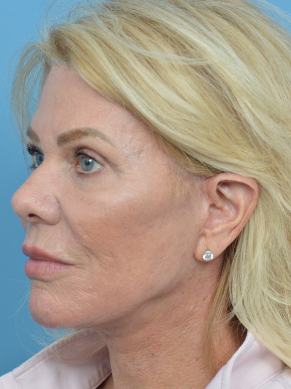 Blepharoplasty Before & After