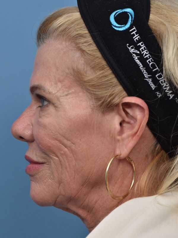 Blepharoplasty Before & After
