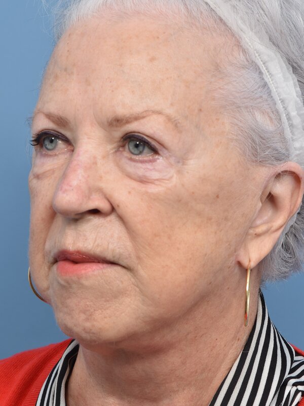 Blepharoplasty Before & After