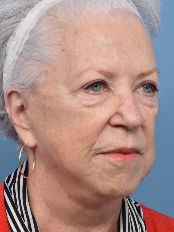 Blepharoplasty Before & After