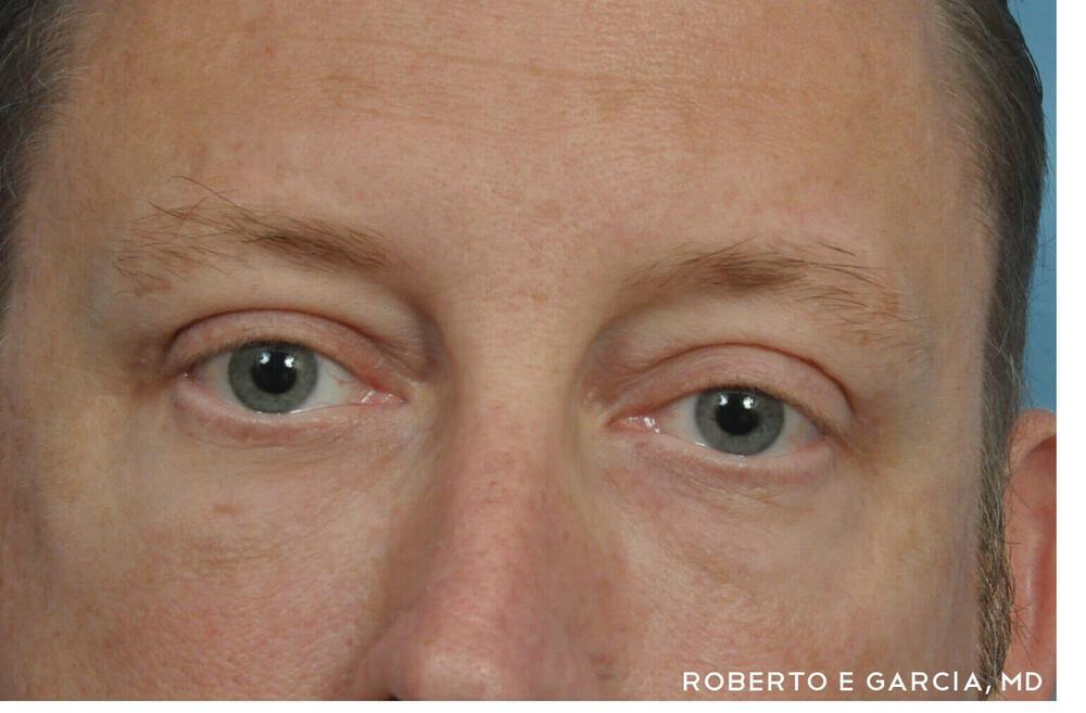 Eyelid Lift Before & After