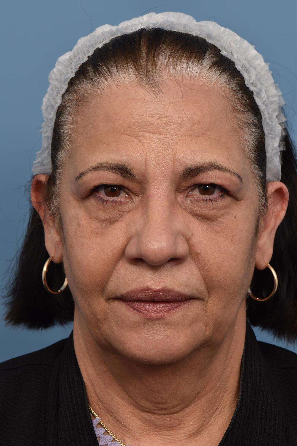 Blepharoplasty Before & After