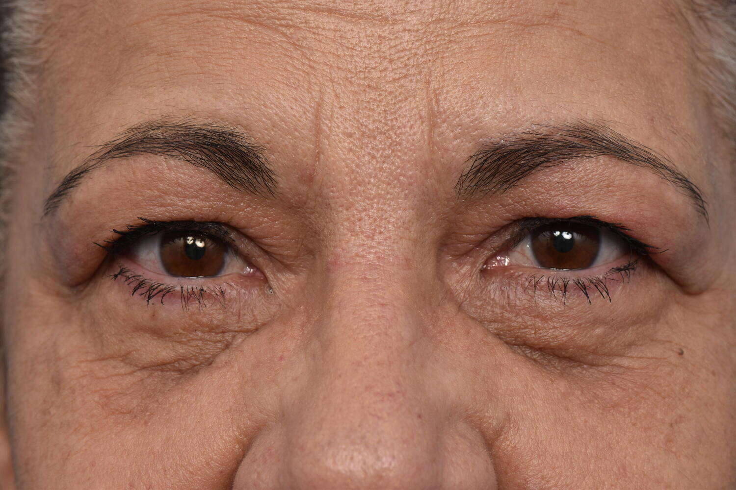 Blepharoplasty Before & After