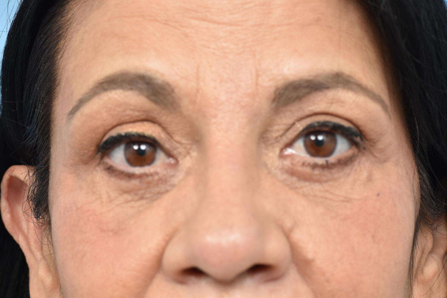 Blepharoplasty Before & After