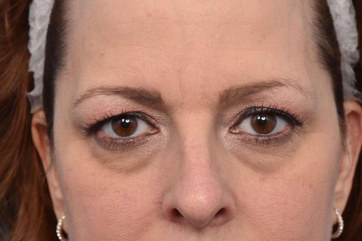 Blepharoplasty Before & After