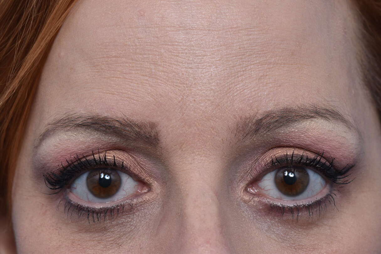 Blepharoplasty Before & After