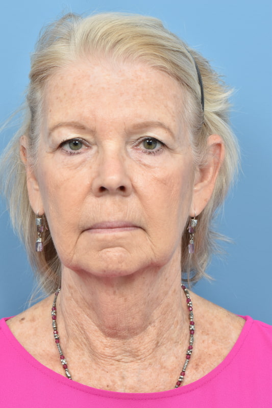 Blepharoplasty Before & After