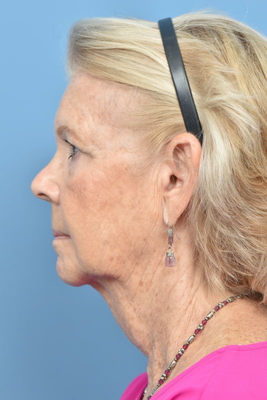 Blepharoplasty Before & After