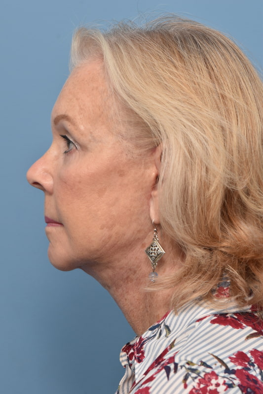 Blepharoplasty Before & After