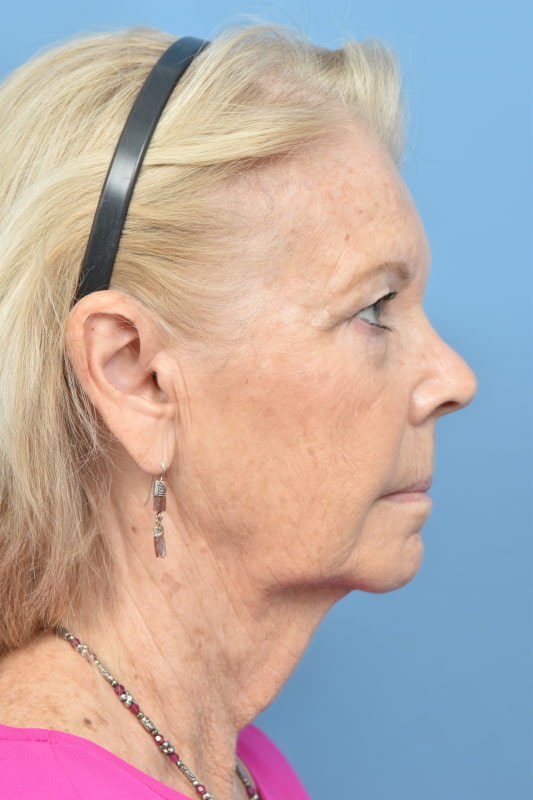 Blepharoplasty Before & After