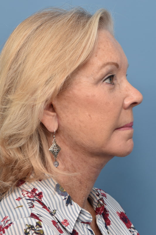 Blepharoplasty Before & After