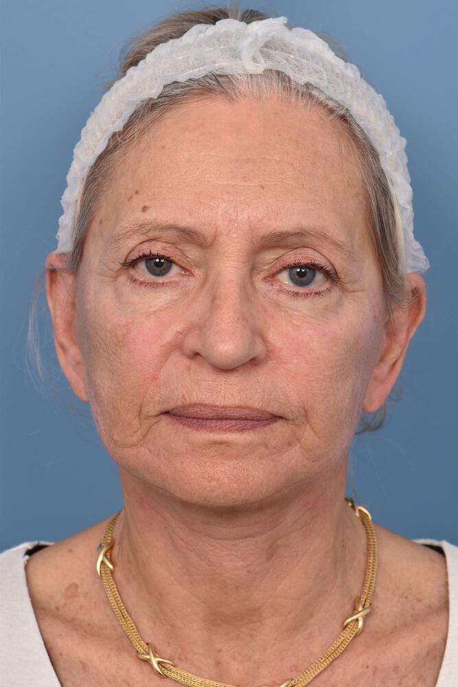 Facelift Before & After