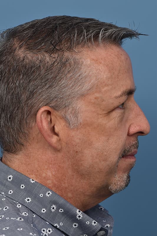 Facelift Before & After