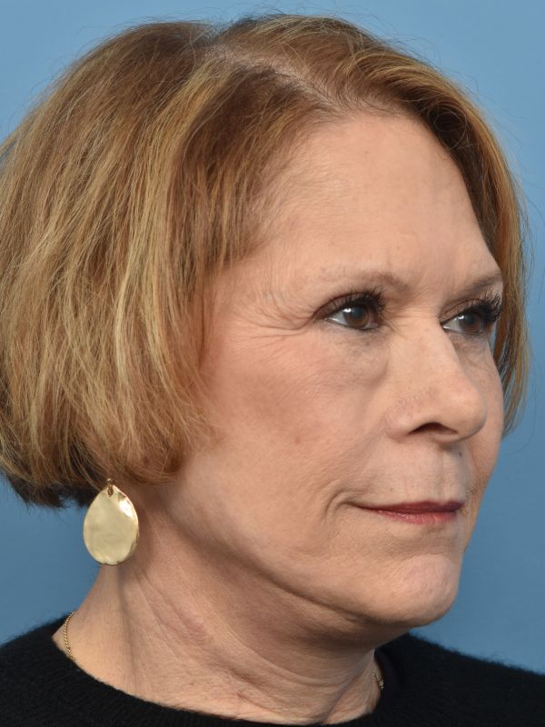 Facelift Before & After