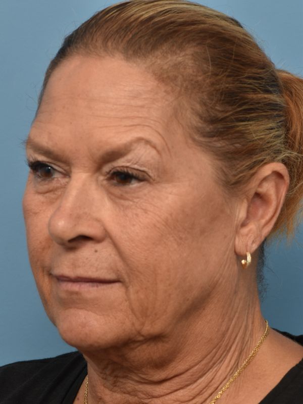 Facelift Before & After