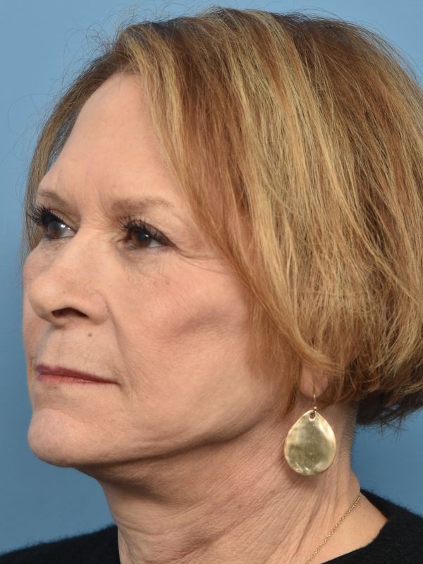 Facelift Before & After