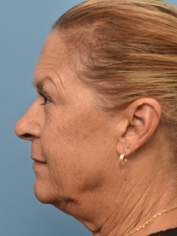 Facelift Before & After